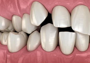 Illustration of spaced-out teeth