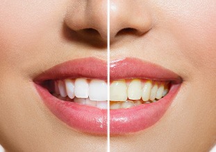 Closeup of a woman’s smile that’s split in half to show results of whitening treatment